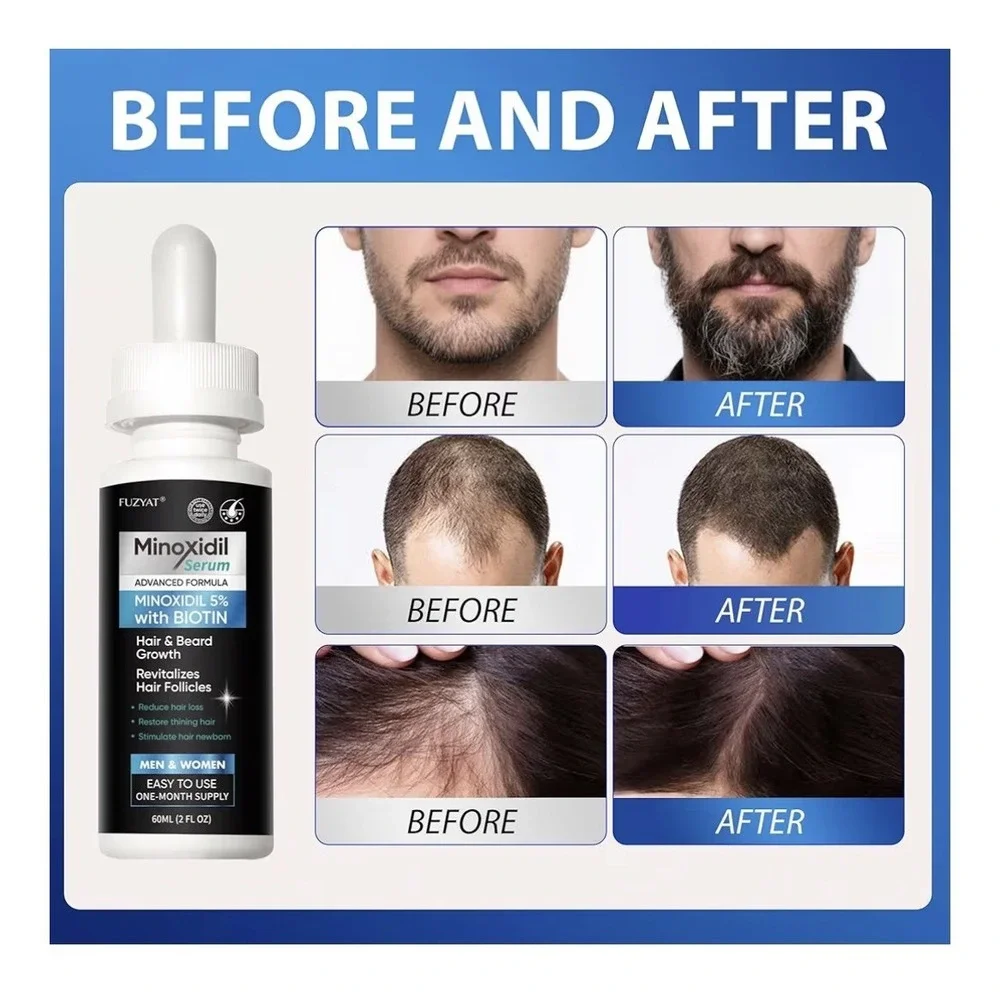 FUZYAT‎ Minoxidil 5% Biotin Serum Extra Strength Hair Beard Growth 240ml